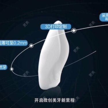 牙齿瓷贴面