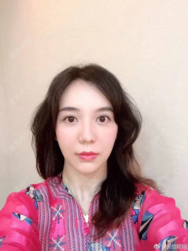 更美 - 悦怡姐姐的私处填充经验 | 私处填充 | 腰腹吸脂 | 吸脂瘦大腿 | 自体脂肪全面部填充