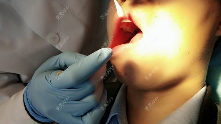 更美 - 更美用户88soGXb1A9的口腔检查经验 | 口腔检查