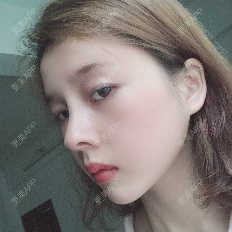 更美 - 449168425的鼻部多项经验 | 肋软骨隆鼻 | 朝天鼻矫正 | 假体垫鼻基底 | 鼻部多项 | 广州