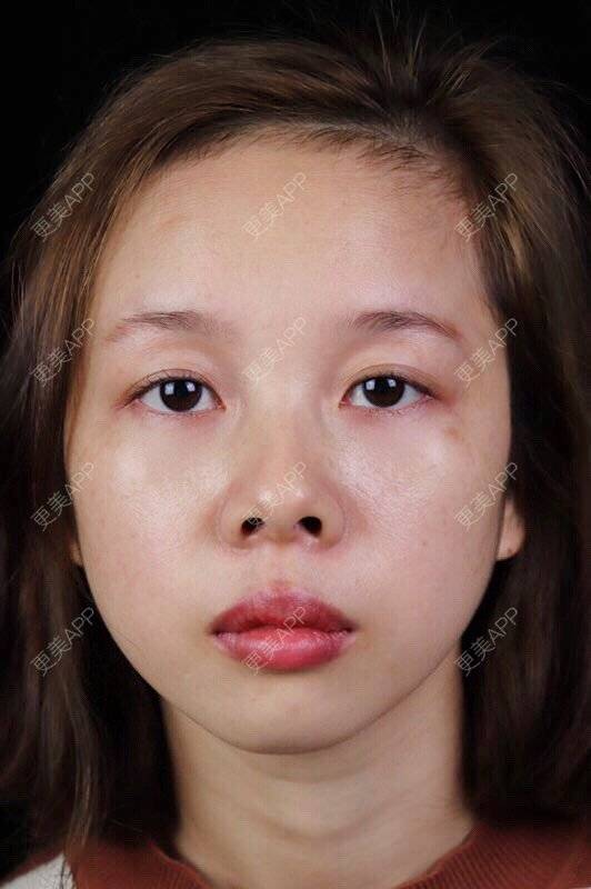 更美 - 449168425的鼻部多项经验 | 肋软骨隆鼻 | 朝天鼻矫正 | 假体垫鼻基底 | 鼻部多项 | 广州
