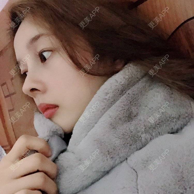 更美 - 449168425的鼻部多项经验 | 肋软骨隆鼻 | 朝天鼻矫正 | 假体垫鼻基底 | 鼻部多项 | 广州