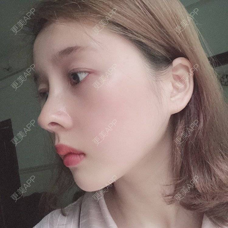 更美 - 449168425的鼻部多项经验 | 肋软骨隆鼻 | 朝天鼻矫正 | 假体垫鼻基底 | 鼻部多项 | 广州