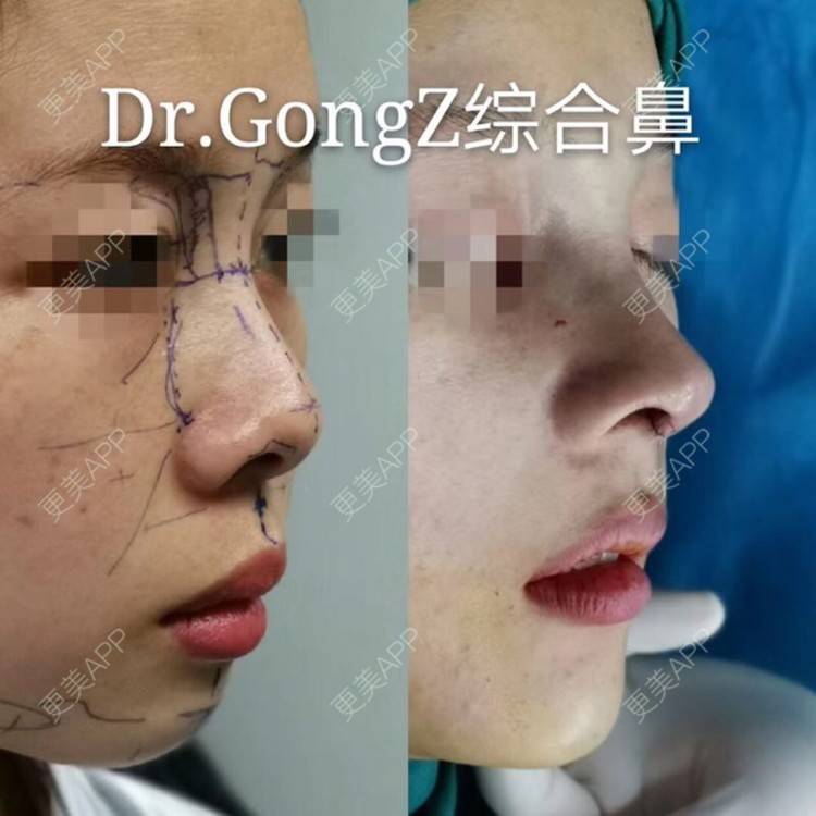 更美 - 449168425的鼻部多项经验 | 肋软骨隆鼻 | 朝天鼻矫正 | 假体垫鼻基底 | 鼻部多项 | 广州