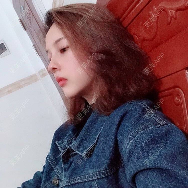 更美 - 449168425的鼻部多项经验 | 肋软骨隆鼻 | 朝天鼻矫正 | 假体垫鼻基底 | 鼻部多项 | 广州