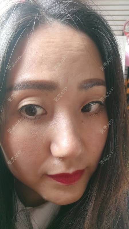 更美 - 更美用户CLTyHXsGdO的超声提升经验 | 超声提升 | 重庆