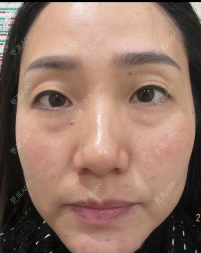更美 - 更美用户CLTyHXsGdO的超声提升经验 | 超声提升 | 重庆
