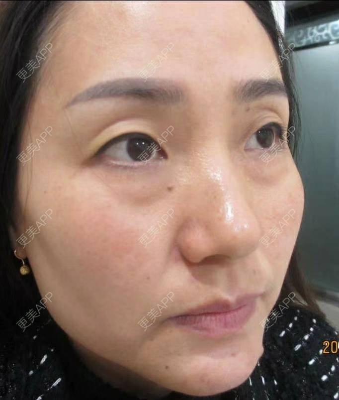 更美 - 更美用户CLTyHXsGdO的超声提升经验 | 超声提升 | 重庆