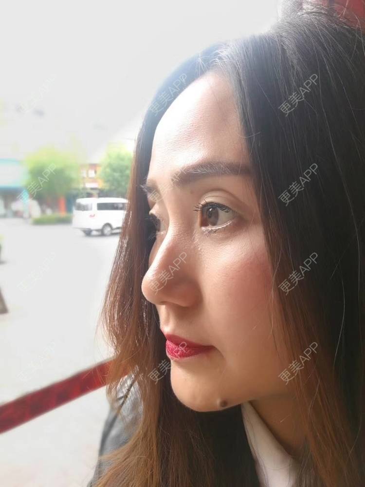 更美 - 更美用户CLTyHXsGdO的超声提升经验 | 超声提升 | 重庆