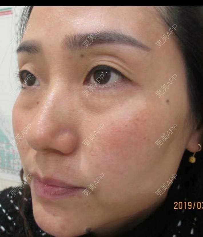 更美 - 更美用户CLTyHXsGdO的超声提升经验 | 超声提升 | 重庆