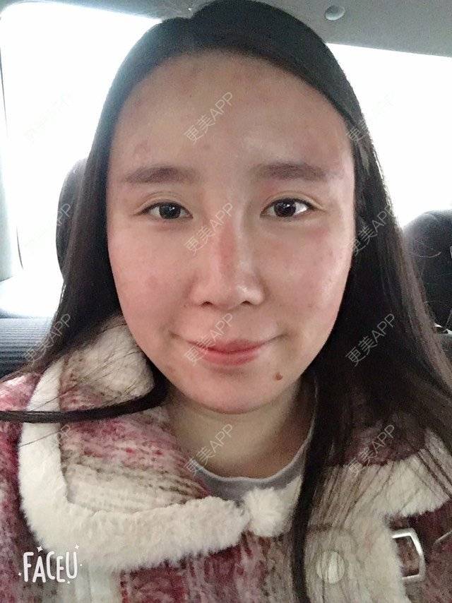 更美 - 付昀柯的鼻部硅胶假体取出经验 | 鼻部硅胶假体取出 | 郑州