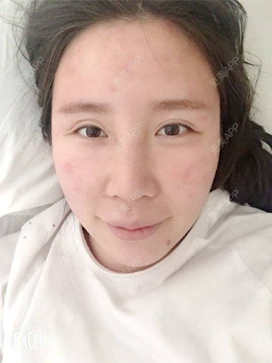 更美 - 付昀柯的鼻部硅胶假体取出经验 | 鼻部硅胶假体取出 | 郑州