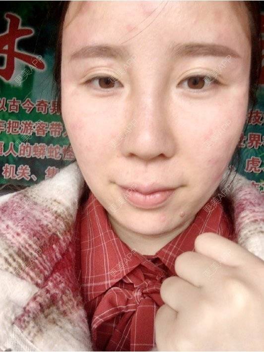 更美 - 付昀柯的鼻部硅胶假体取出经验 | 郑州 | 鼻部硅胶假体取出