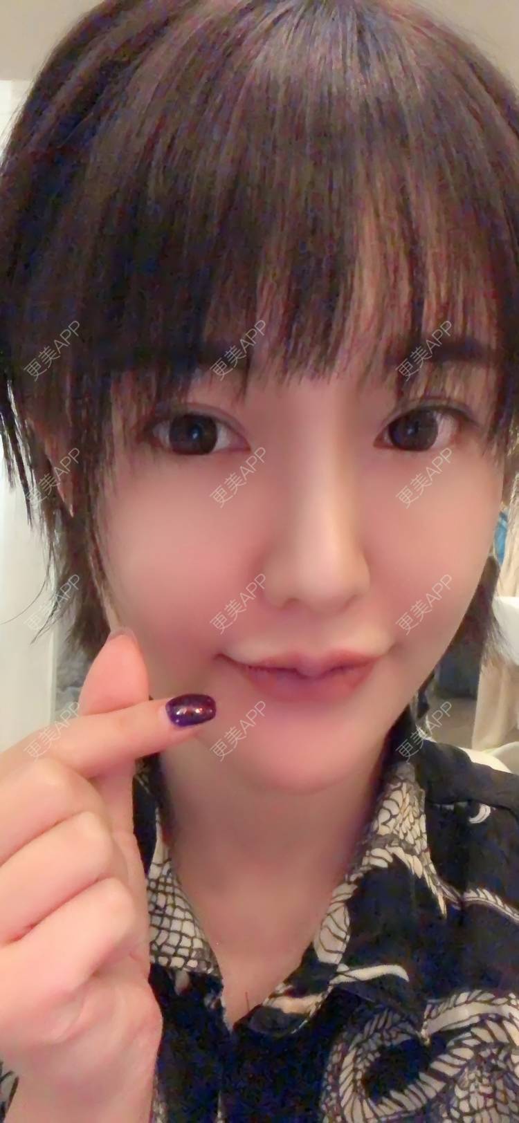 更美用户pd7jekbfig的m唇成形日记