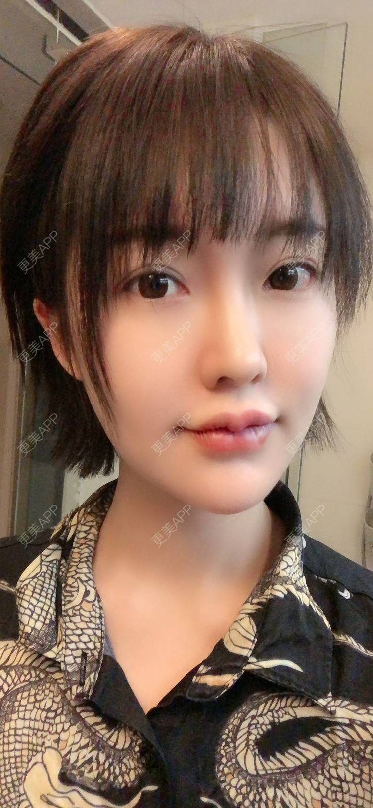 更美用户pd7jekbfig的m唇成形日记