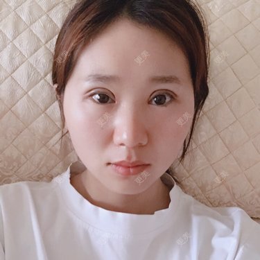 全切双眼皮