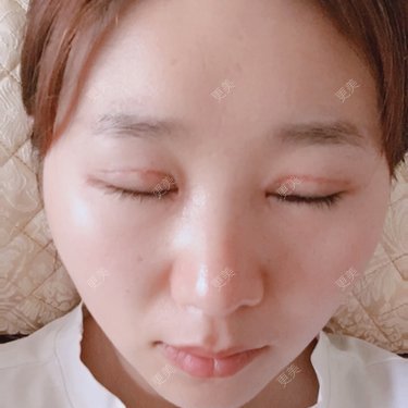 全切双眼皮