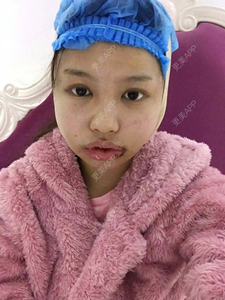 更美用户nveb5lf7wo的下颌角切除术日记