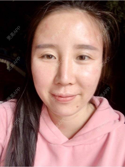 更美 - 付昀柯的鼻部硅胶假体取出经验 | 郑州 | 鼻部硅胶假体取出