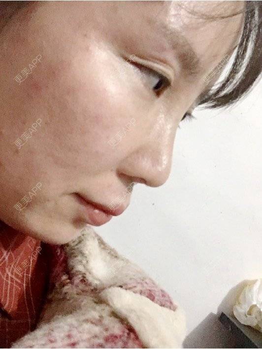更美 - 付昀柯的鼻部硅胶假体取出经验 | 郑州 | 鼻部硅胶假体取出
