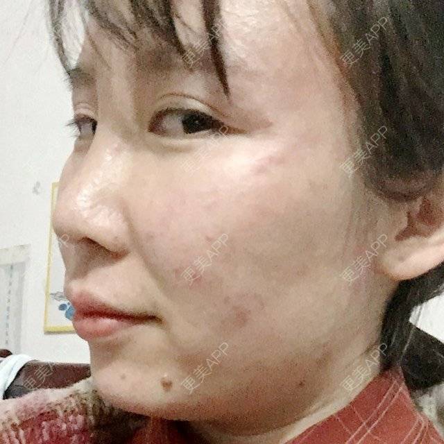 更美 - 付昀柯的鼻部硅胶假体取出经验 | 郑州 | 鼻部硅胶假体取出