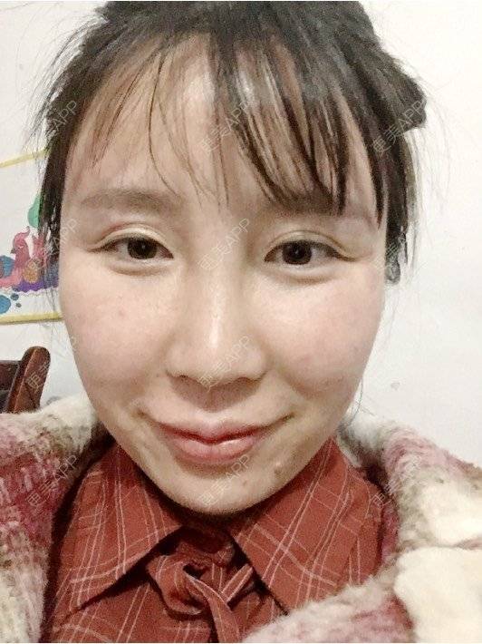 更美 - 付昀柯的鼻部硅胶假体取出经验 | 郑州 | 鼻部硅胶假体取出