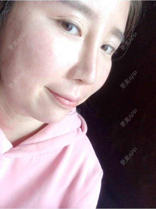 更美 - 付昀柯的鼻部硅胶假体取出经验 | 郑州 | 鼻部硅胶假体取出