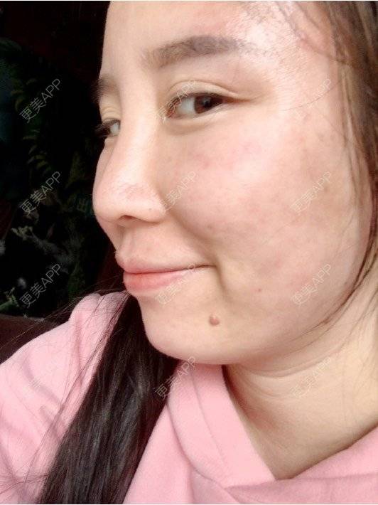 更美 - 付昀柯的鼻部硅胶假体取出经验 | 郑州 | 鼻部硅胶假体取出