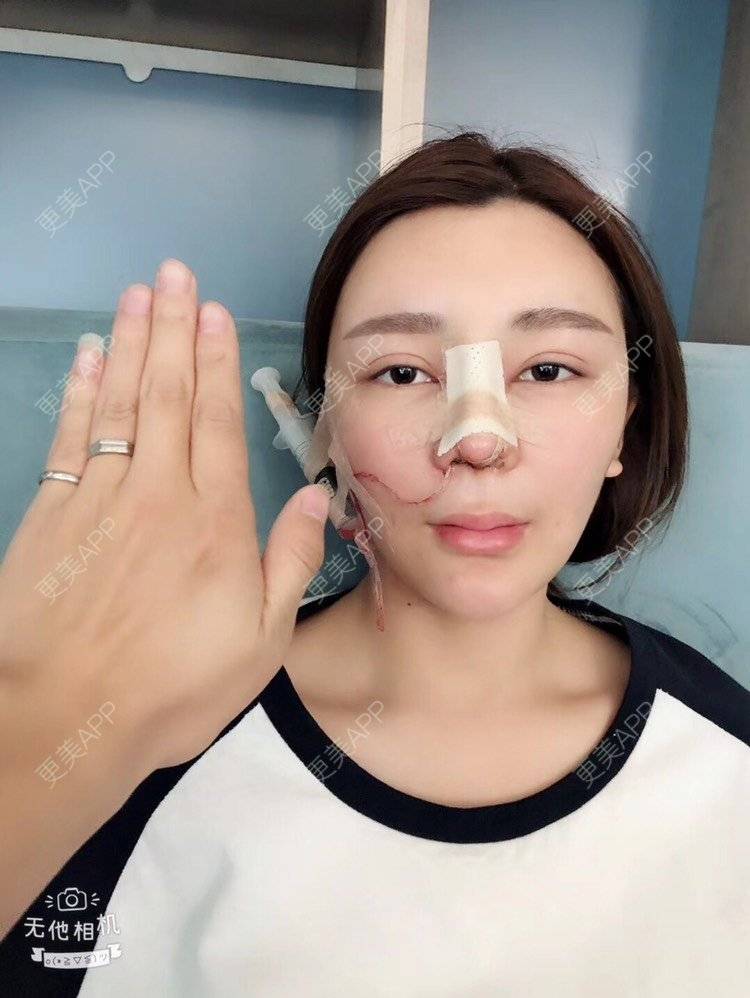 更美 - 祢的美丽/我的职责的定点双眼皮经验 | 定点双眼皮 | 肋软骨隆鼻 | 颧骨填充 | 上海