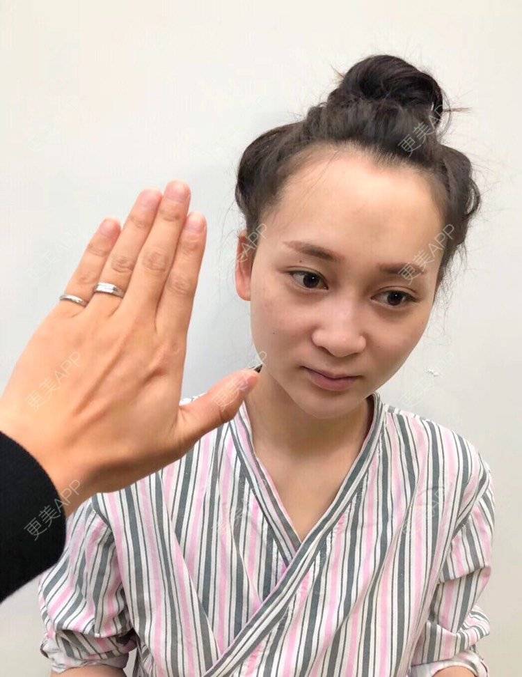 更美 - 祢的美丽/我的职责的定点双眼皮经验 | 定点双眼皮 | 肋软骨隆鼻 | 颧骨填充 | 上海