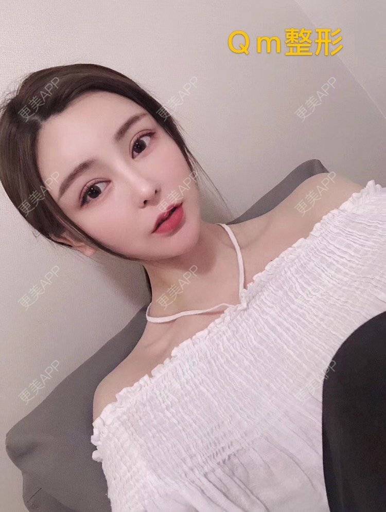 更美 - 祢的美丽/我的职责的定点双眼皮经验 | 定点双眼皮 | 肋软骨隆鼻 | 颧骨填充 | 上海