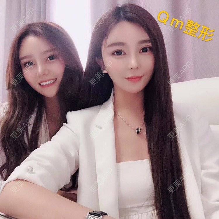 更美 - 祢的美丽/我的职责的定点双眼皮经验 | 定点双眼皮 | 肋软骨隆鼻 | 颧骨填充 | 上海