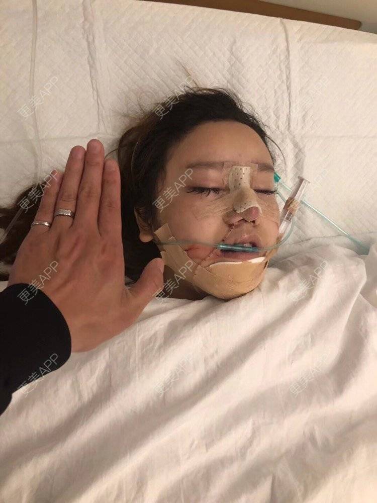 更美 - 祢的美丽/我的职责的定点双眼皮经验 | 定点双眼皮 | 肋软骨隆鼻 | 颧骨填充 | 上海