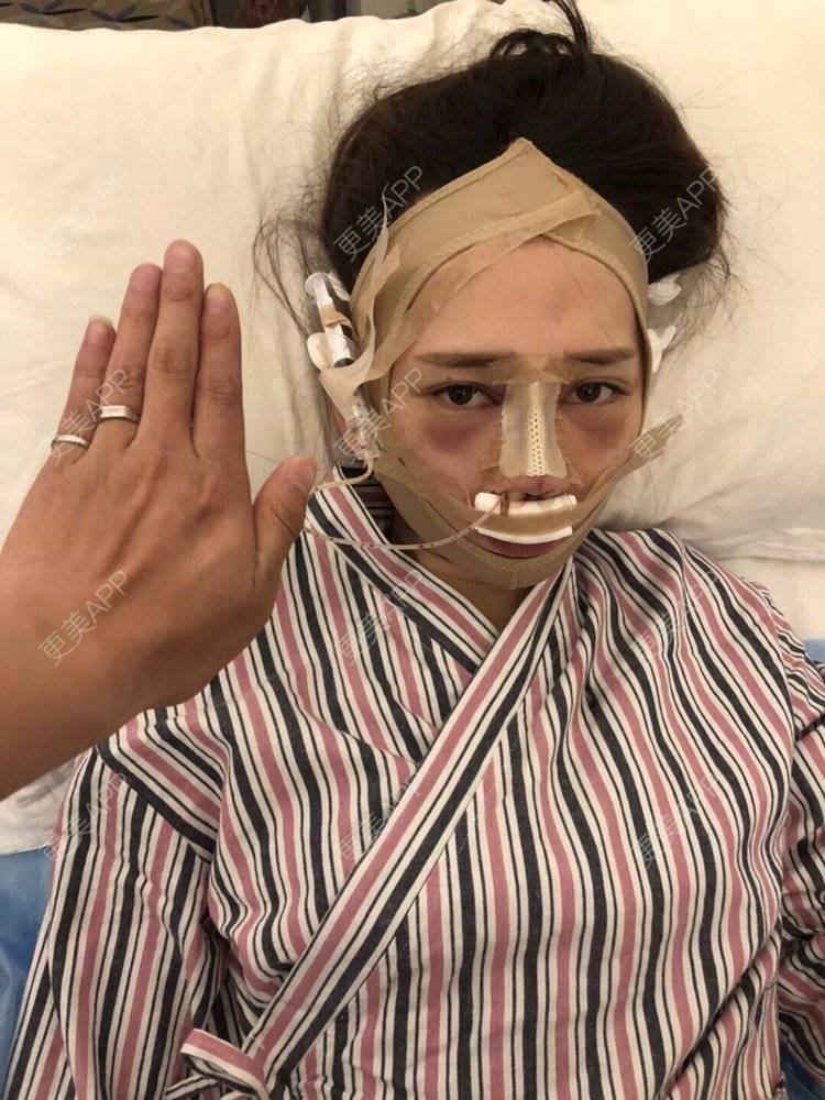 更美 - 祢的美丽/我的职责的定点双眼皮经验 | 定点双眼皮 | 肋软骨隆鼻 | 颧骨填充 | 上海