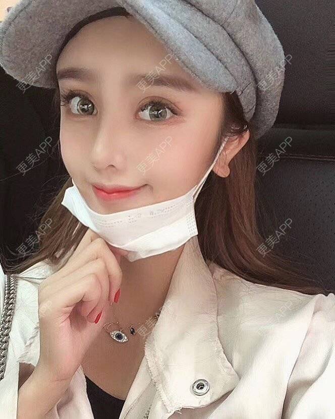 更美 - 祢的美丽/我的职责的定点双眼皮经验 | 定点双眼皮 | 肋软骨隆鼻 | 颧骨填充 | 上海