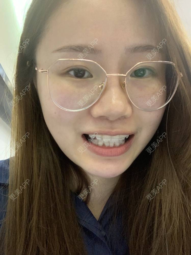 更美 - ahah的牙齿矫正经验 | 牙齿矫正 | 广州