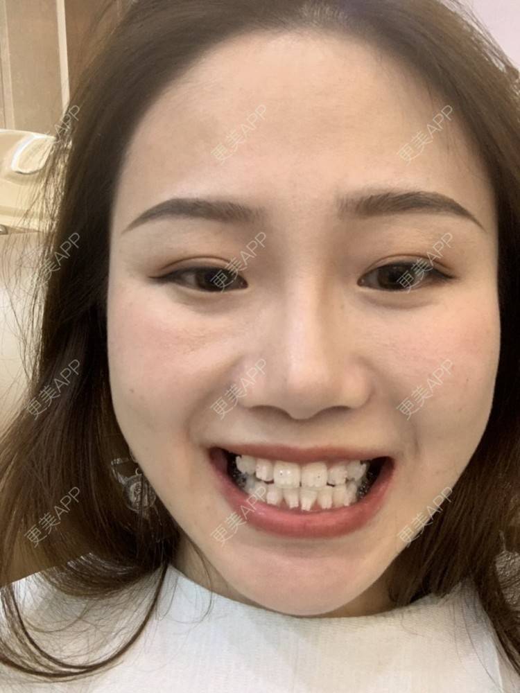 更美 - ahah的牙齿矫正经验 | 牙齿矫正 | 广州