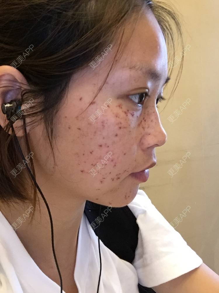 更美 - 更美用户NhkfCnPZdC的激光淡斑经验 | 激光淡斑 | 祛斑祛色素 | 化学剥脱淡斑