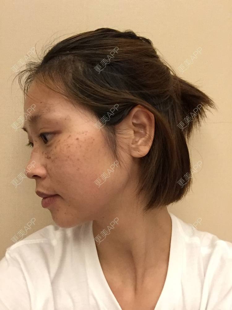 更美 - 更美用户NhkfCnPZdC的激光淡斑经验 | 激光淡斑 | 祛斑祛色素 | 化学剥脱淡斑