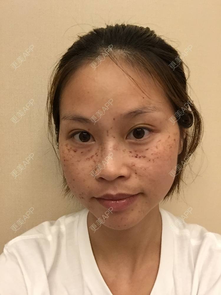 更美 - 更美用户NhkfCnPZdC的激光淡斑经验 | 激光淡斑 | 祛斑祛色素 | 化学剥脱淡斑