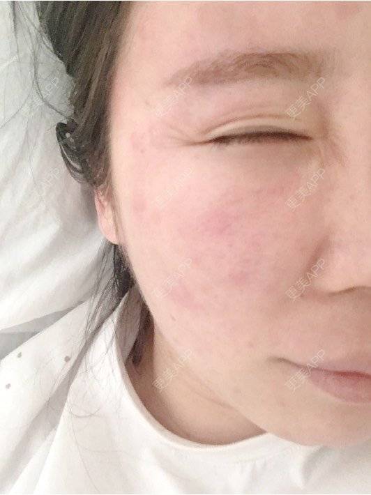 更美 - 付昀柯的鼻部硅胶假体取出经验 | 郑州 | 鼻部硅胶假体取出