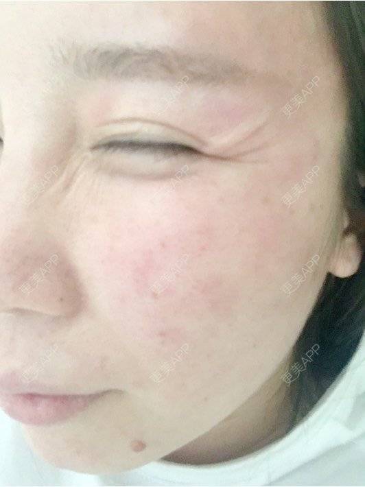 更美 - 付昀柯的鼻部硅胶假体取出经验 | 郑州 | 鼻部硅胶假体取出