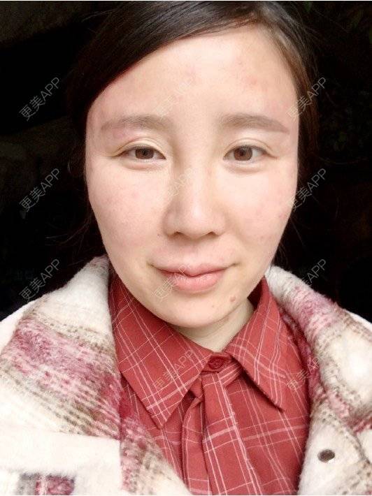 更美 - 付昀柯的鼻部硅胶假体取出经验 | 郑州 | 鼻部硅胶假体取出