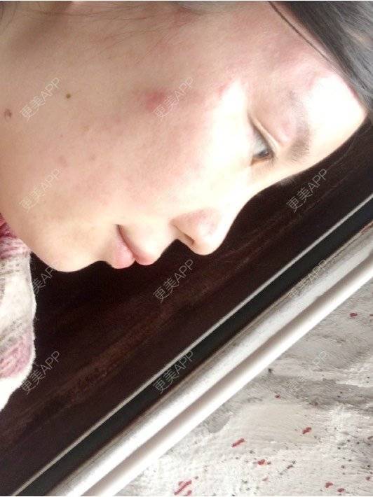 更美 - 付昀柯的鼻部硅胶假体取出经验 | 郑州 | 鼻部硅胶假体取出