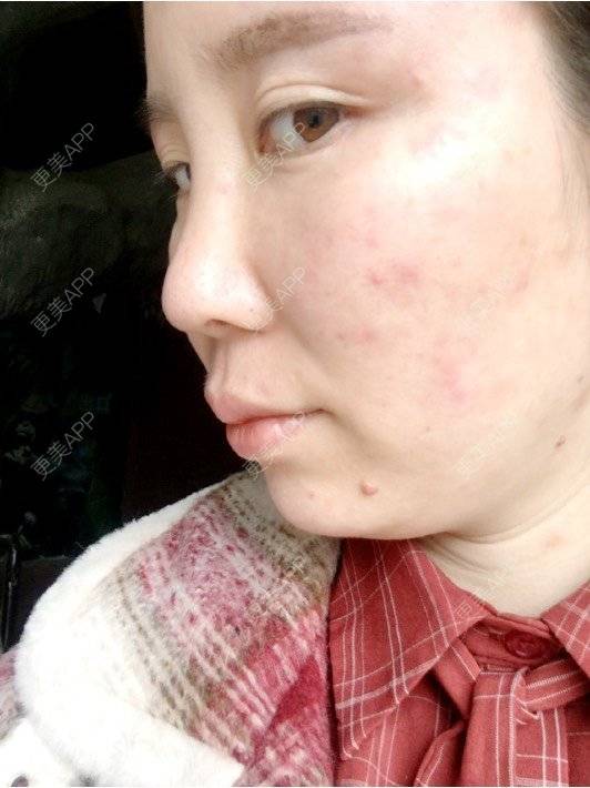 更美 - 付昀柯的鼻部硅胶假体取出经验 | 郑州 | 鼻部硅胶假体取出