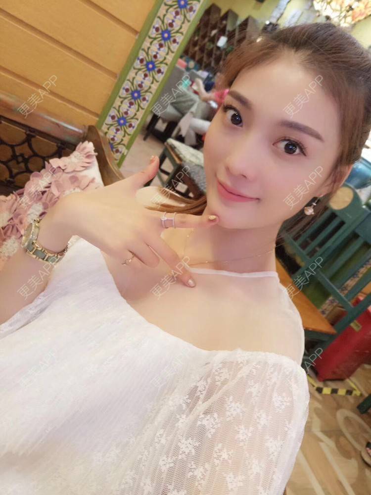 更美 - 堕精哲的玻尿酸面颊经验 | 玻尿酸面颊