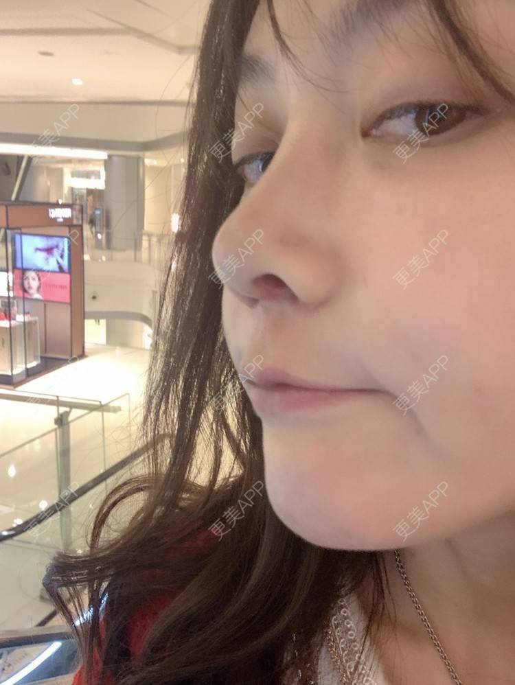 更美 - clr哥的膨体隆鼻经验 | 膨体隆鼻 | 肋软骨隆鼻 | 鼻翼缩小 | 成都 | 鼻孔矫正 | 鼻小柱延长