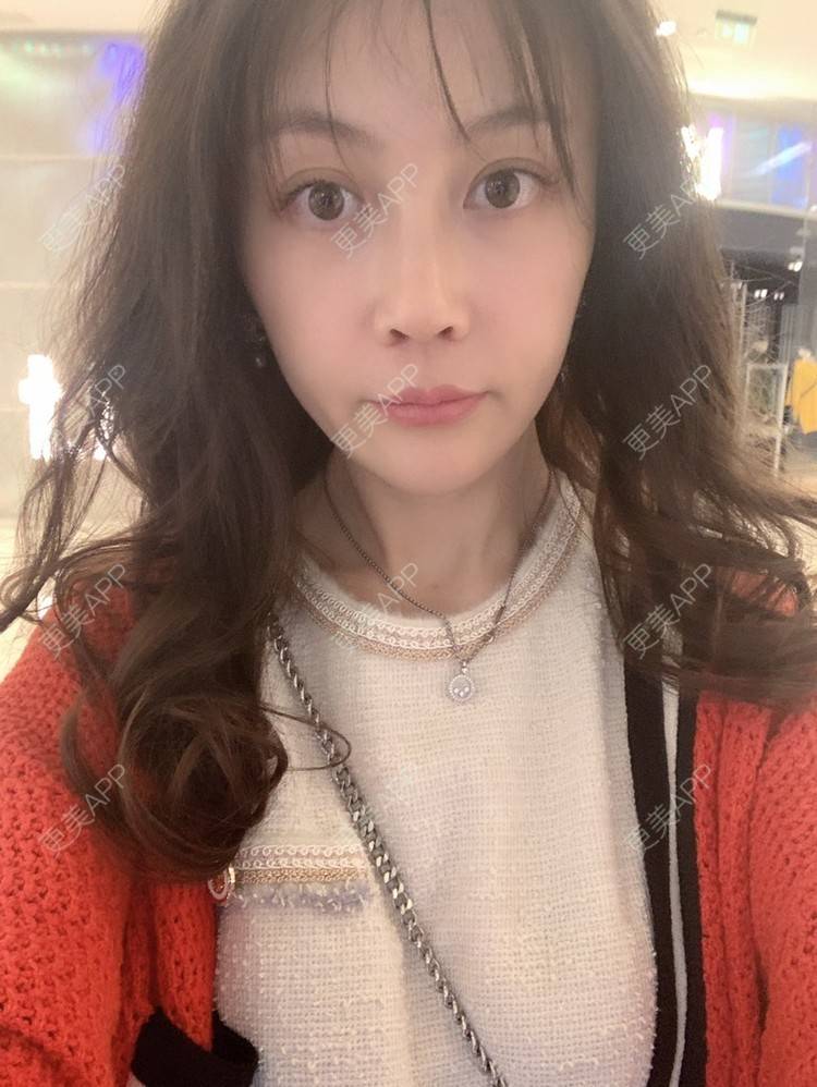 更美 - clr哥的膨体隆鼻经验 | 膨体隆鼻 | 肋软骨隆鼻 | 鼻翼缩小 | 成都 | 鼻孔矫正 | 鼻小柱延长