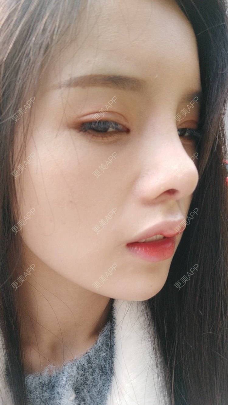 超级秀气的蓝蓝的肋软骨隆鼻日记