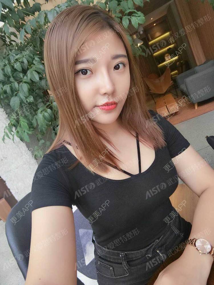更美 - 佳佳good的鼻部多项经验 | 鼻部多项 | 手术缩鼻头 | 肋软骨隆鼻 | 鼻翼缩小 | 武汉